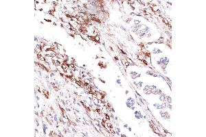 Immunohistochemistry of paraffin-embedded human lung cancer using Vimentin antibody (ABIN3016291, ABIN3016292, ABIN3016293 and ABIN6219693) at dilution of 1:100 (40x lens). (Vimentin anticorps  (AA 1-200))
