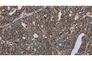 Immunohistochemistry of paraffin-embedded Human ovarian cancer using NDUFA13 Polyclonal Antibody at dilution of 1:50