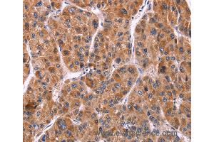 Immunohistochemistry of Human gastric cancer using EFNA5 Polyclonal Antibody at dilution of 1:40 (Ephrin A5 anticorps)