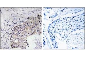 Immunohistochemistry analysis of paraffin-embedded human breast carcinoma, using SCARF2 Antibody. (SCARF2 anticorps  (AA 677-726))