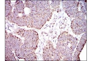 Immunohistochemical analysis of paraffin-embedded rectum cancer tissues using ALDH2 mouse mAb with DAB staining.