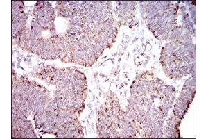 Immunohistochemical analysis of paraffin-embedded rectum cancer tissues using ALDH2 mouse mAb with DAB staining. (ALDH2 anticorps  (AA 317-517))