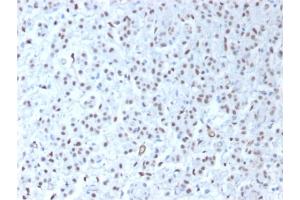 Formalin-fixed, paraffin-embedded human Mesothelioma stained with Wilm's Tumor Rabbit Recombinant Monoclonal Antibody (WT1/1434R). (Recombinant WT1 anticorps)