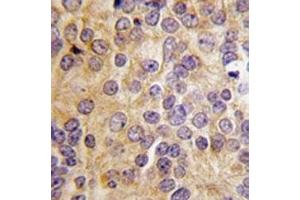 IHC analysis of FFPE human prostate carcinoma tissue stained with PRMT3 antibody (PRMT3 anticorps  (AA 142-173))