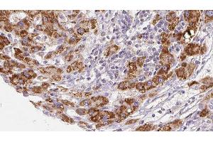 ABIN6277936 at 1/100 staining Human liver cancer tissue by IHC-P. (PNPLA2 anticorps  (Internal Region))