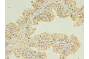 Immunohistochemistry of paraffin-embedded human prostate cancer using ABIN7174434 at dilution of 1:100