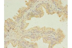 Immunohistochemistry of paraffin-embedded human prostate cancer using ABIN7174434 at dilution of 1:100 (UBE2D1 anticorps  (AA 1-147))