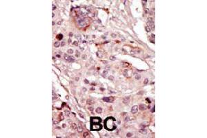 Formalin-fixed and paraffin-embedded human cancer tissue reacted with SRMS polyclonal antibody  , which was peroxidase-conjugated to the secondary antibody, followed by AEC staining. (SRMS anticorps  (C-Term))