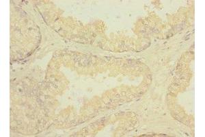 Immunohistochemistry of paraffin-embedded human prostate cancer using ABIN7168448 at dilution of 1:100 (RGR anticorps  (AA 152-291))