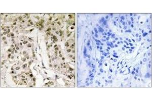Immunohistochemistry analysis of paraffin-embedded human breast carcinoma tissue, using HCFC1 Antibody. (HCFC1 anticorps  (AA 131-180))