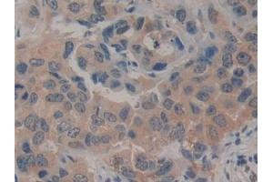 Detection of CD161 in Human Breast cancer Tissue using Polyclonal Antibody to Cluster Of Differentiation 161 (CD161)