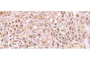 Immunohistochemistry of paraffin-embedded Human tonsil tissue using DDI2 Polyclonal Antibody at dilution of 1:75(x200)