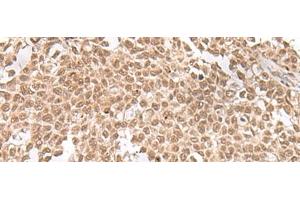 Immunohistochemistry of paraffin-embedded Human ovarian cancer tissue using ZNF560 Polyclonal Antibody at dilution of 1:25(x200) (ZNF560 anticorps)