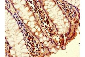 Immunohistochemistry of paraffin-embedded human colon cancer using ABIN7173790 at dilution of 1:100