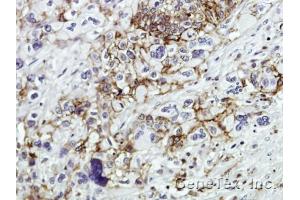 IHC-P Image Immunohistochemical analysis of paraffin-embedded Human pancreatic tumor, using CD44, antibody at 1:100 dilution. (CD44 anticorps)