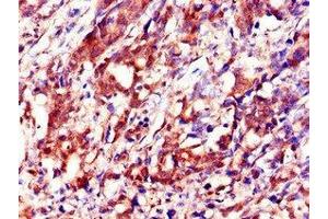 Immunohistochemistry of paraffin-embedded human gastric cancer using ABIN7156360 at dilution of 1:100 (IGF2BP3 anticorps  (AA 1-100))