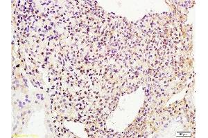 Formalin-fixed and human breast carcinoma tissue labeled with Anti-phospho-BACH1/BRIP1(Ser990) Polyclonal Antibody, Unconjugated  at 1:200 followed by conjugation to the secondary antibody and DAB staining