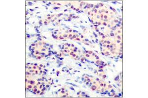 Immunohistochemical analysis of paraffin-embedded human breast carcinoma tissue using JunD (epitope around residue 255) antibody (ABIN5976225).