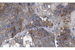 ABIN6269074 at 1/100 staining human breast tissues sections by IHC-P. (EGFR anticorps  (Internal Region))