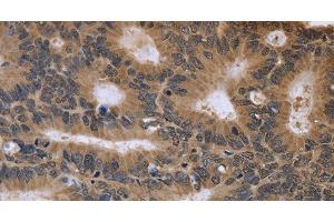 Immunohistochemistry of paraffin-embedded Human colon cancer tissue using FGFR1OP2 Polyclonal Antibody at dilution 1:40 (FGFR1OP2 anticorps)