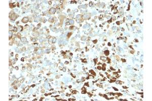 Formalin-fixed, paraffin-embedded human Melanoma stained with NGFR Rabbit Recombinant Monoclonal Antibody (NGFR/2550R).