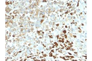 Formalin-fixed, paraffin-embedded human Melanoma stained with NGFR Rabbit Recombinant Monoclonal Antibody (NGFR/2550R). (Recombinant NGFR anticorps  (AA 281-421))