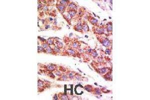 Formalin-fixed and paraffin-embedded human hepatocellular carcinoma tissue reacted with USP12 polyclonal antibody  , which was peroxidase-conjugated to the secondary antibody, followed by AEC staining . (USP12 anticorps  (N-Term))