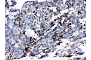 Anti- Ataxin 1 Picoband antibody, IHC(P) IHC(P): Human Lung Cancer Tissue (Ataxin 1 anticorps  (C-Term))