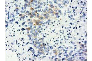 Immunohistochemical staining of paraffin-embedded Adenocarcinoma of Human ovary tissue using anti-LIN7B mouse monoclonal antibody. (LIN7B anticorps)