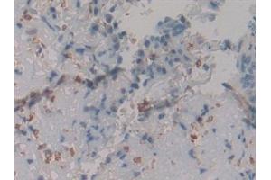 Detection of CR in Human Skin cancer Tissue using Polyclonal Antibody to Calretinin (CR) (Calretinin anticorps  (AA 28-248))