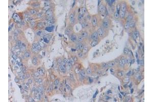 Detection of CTSV in Human Colorectal cancer Tissue using Polyclonal Antibody to Cathepsin V (CTSV) (Cathepsin L2 anticorps  (AA 64-334))