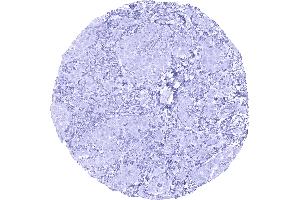EPCAM immunostaining is lacking in an epitheloid malignant mesothelioma