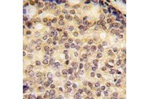 IHC analysis of FFPE human prostate carcinoma tissue stained with SOX9 antibody