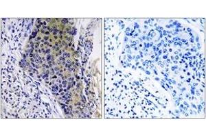 Immunohistochemistry analysis of paraffin-embedded human lung carcinoma tissue, using MRPL34 Antibody. (MRPL34 anticorps  (AA 21-70))