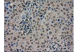 Immunohistochemical staining of paraffin-embedded Carcinoma of thyroid tissue using anti-SCYL3mouse monoclonal antibody. (SCYL3 anticorps)