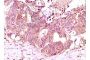 Immunohistochemical analysis of paraffin-embedded human recturn adenocarcinoma tissue showing cytoplasmic localization using FGF2 monoclonal antibody, clone 2H5G2C11  with DAB staining. (FGF2 anticorps)