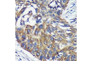 Immunohistochemistry of paraffin-embedded Human lung cancer using L Rabbit pAb (ABIN7265386) at dilution of 1:100 (40x lens).