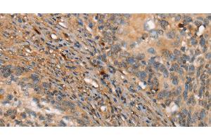 Immunohistochemistry of paraffin-embedded Human cervical cancer tissue using HK3 Polyclonal Antibody at dilution 1:40 (HK3 anticorps)