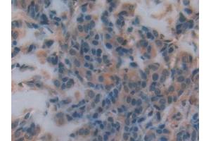 Detection of CD55 in Human Breast cancer Tissue using Polyclonal Antibody to Cluster Of Differentiation 55 (CD55)