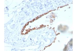 Formalin-fixed, paraffin-embedded human Lung Mesothelioma stained with Mesothelin Mouse Monoclonal Antibody (MSLN/3384).