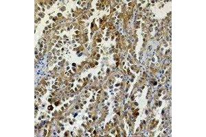 Immunohistochemical analysis of Carbonic Anhydrase 9 staining in human lung cancer formalin fixed paraffin embedded tissue section. (CA9 anticorps)