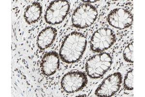 ABIN6267309 at 1/200 staining human colon cancer tissue sections by IHC-P. (C-JUN anticorps  (pSer73))