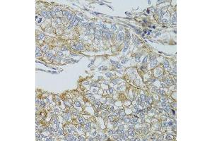 Immunohistochemistry of paraffin-embedded human gastric cancer using CHMP4B antibody. (CHMP4B anticorps  (AA 1-224))