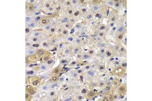 Immunohistochemistry of paraffin-embedded human liver cancer using MAD1L1 antibody at dilution of 1:100 (400x lens). (MAD1L1 anticorps)
