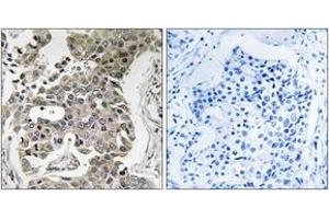Immunohistochemistry analysis of paraffin-embedded human breast carcinoma tissue, using PPP2R1B Antibody. (PPP2R1B anticorps  (AA 552-601))