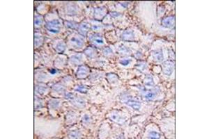 Formalin-fixed and paraffin-embedded human breast carcinoma tissue reacted with ERK8 antibody (N-term), which was peroxidase-conjugated to the secondary antibody, followed by DAB staining.