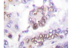 Immunohistochemistry analyzes of AML1 antibody in paraffin-embedded human lung carcinoma tissue. (RUNX1 anticorps)