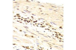 Immunohistochemistry of paraffin-embedded human gastric cancer using PRPF3 Antibody. (PRPF3 anticorps  (AA 1-280))