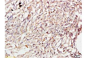 Formalin-fixed and paraffin embedded human lung carcinoma labeled with Anti-ROCK1 Polyclonal Antibody, Unconjugated (ABIN738636) at 1:200 followed by conjugation to the secondary antibody and DAB staining. (ROCK1 anticorps  (AA 1001-1200))