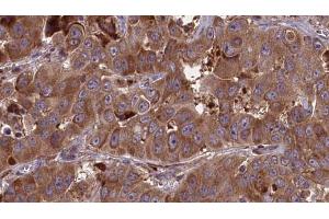 ABIN6273681 at 1/100 staining Human liver cancer tissue by IHC-P. (JAML anticorps  (C-Term))
